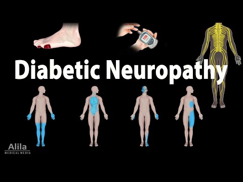 Diabetic Neuropathy, Animation